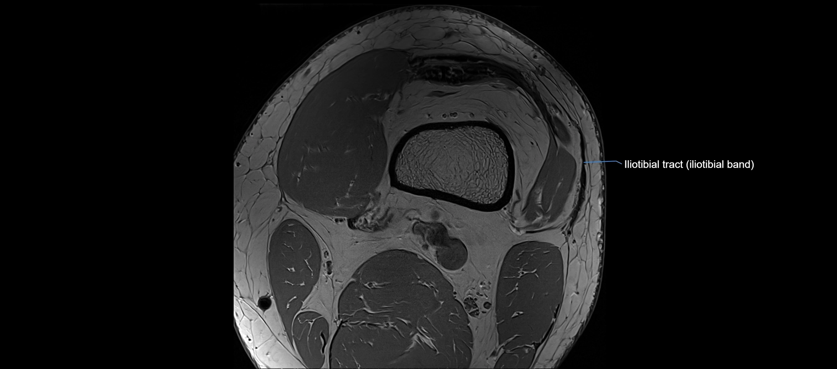 MRI Knee axial  ligaments cross sectional anatomy 3T  radiology  image-img-03001-00001.webp